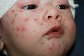 Mụn nước thủy đậu - các giai đoạn
