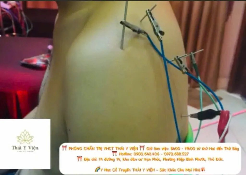 Bệnh nhân châm cứu điều trị đau cánh tay tại Thái Y Viện