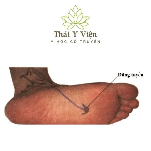 Huyệt Dũng Tuyền (KI1)