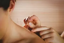 Châm cứu trị liệt mặt