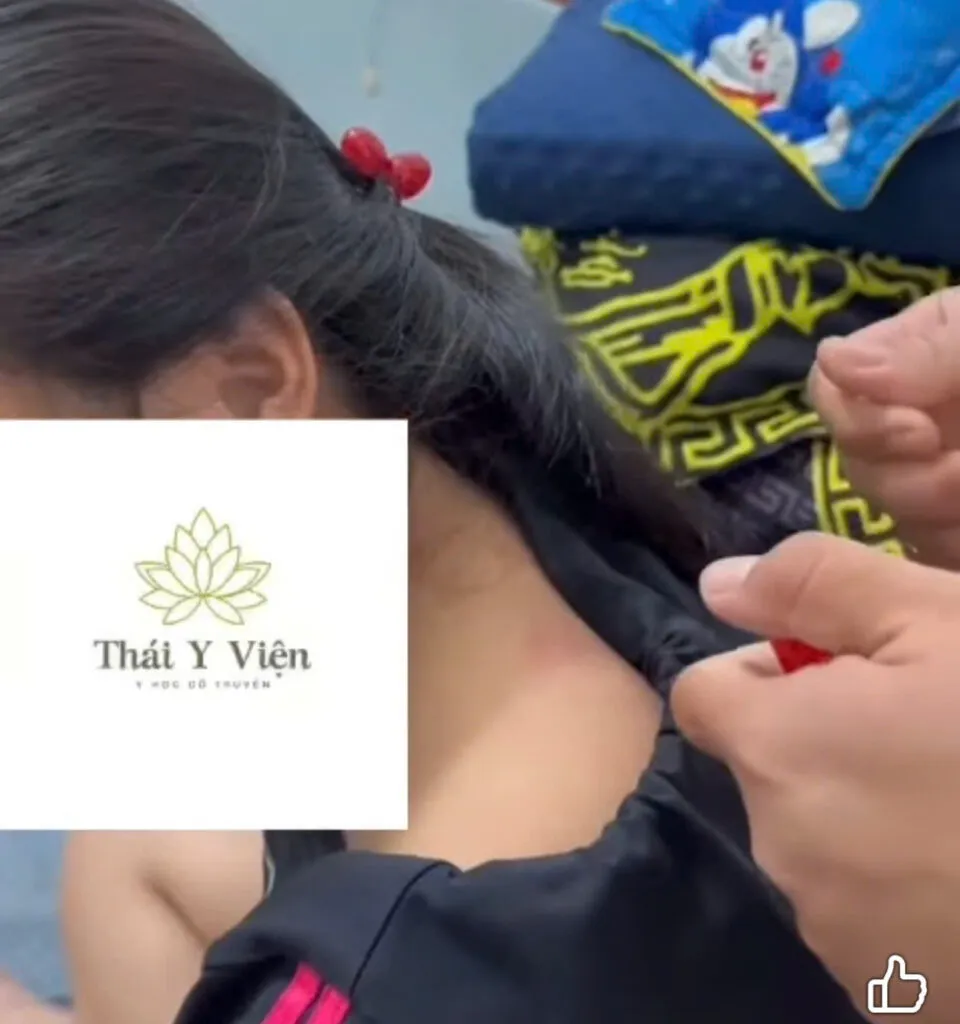 Hỏa Châm: Phương Pháp Trị Liệu Cổ Truyền Đặc Biệt Trong Đông Y