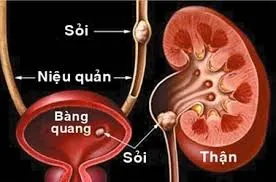 Tinh thể sỏi bàng quang