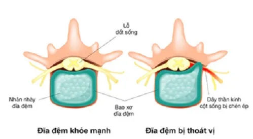 Cấu tạo đĩa đệm cột sống