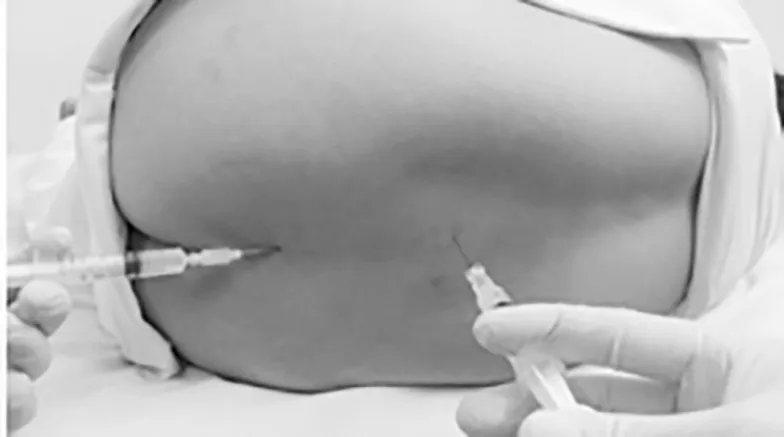 Điều trị thoát vị đĩa đệm