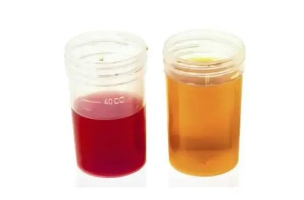 Tiểu ra máu - cần xét nghiệm để xác định nguyên nhân