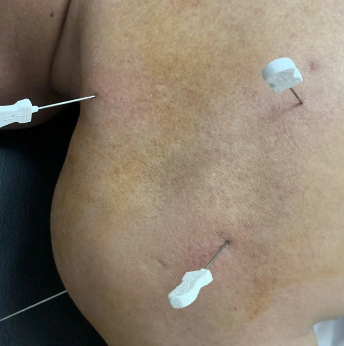 Tiểu Đao Châm - Phương pháp trị liệu độc đáo tại Thái Y Viện